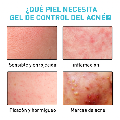 IF - Gel Reparador de Acné Jayusing desvanece las marcas y manchas de acné, repara, hidrata e ilumina la piel.