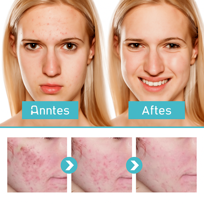 IF - Gel Reparador de Acné Jayusing desvanece las marcas y manchas de acné, repara, hidrata e ilumina la piel.