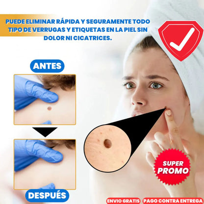 Eliminador de Verrugas Instantáneo - G